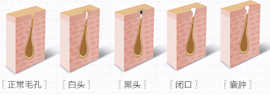 长闭口了怎么办！告诉你答案哦