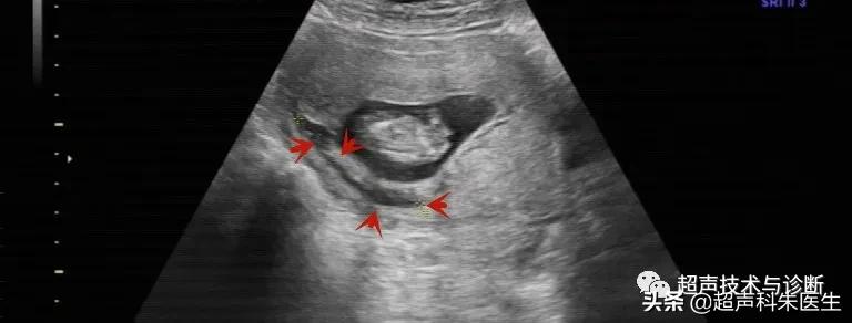 绒毛膜下血肿的超声鉴别诊断,绒毛膜下血肿的症状