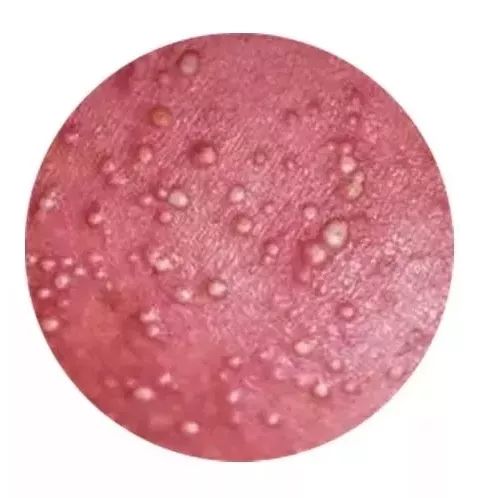 夏天宝宝长痱子怎么办,宝宝夏季长痱子怎么办