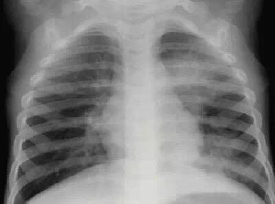 哪种病毒感染肺炎最难治,这次病毒肺炎是否严重