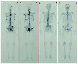 前列腺癌骨转移护理问题和措施,前列腺癌晚期骨转移最后遭罪吗