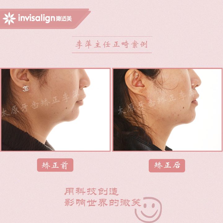 太原矫正牙齿需要做正颌吗,太原牙齿二次矫正