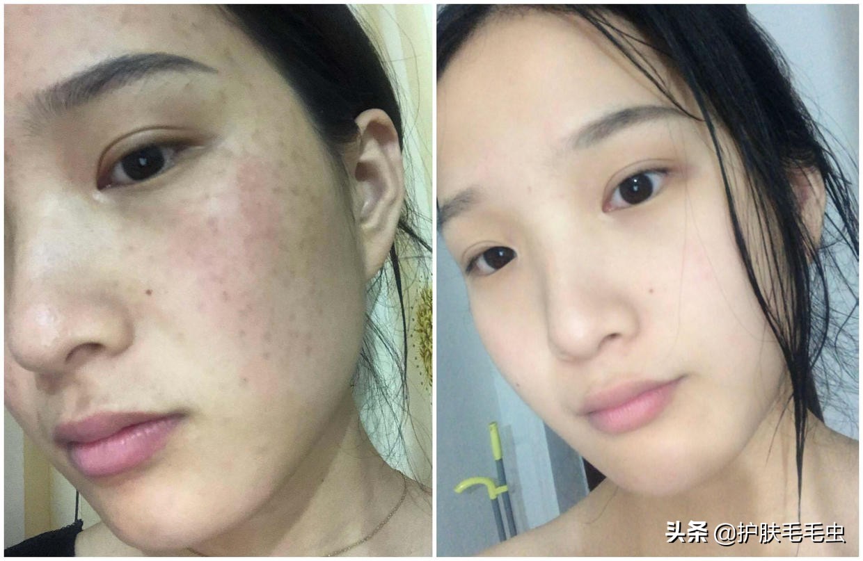 脸颊两侧长斑怎样祛除效果最佳,脸颊两边长斑最有效的淡化妙招