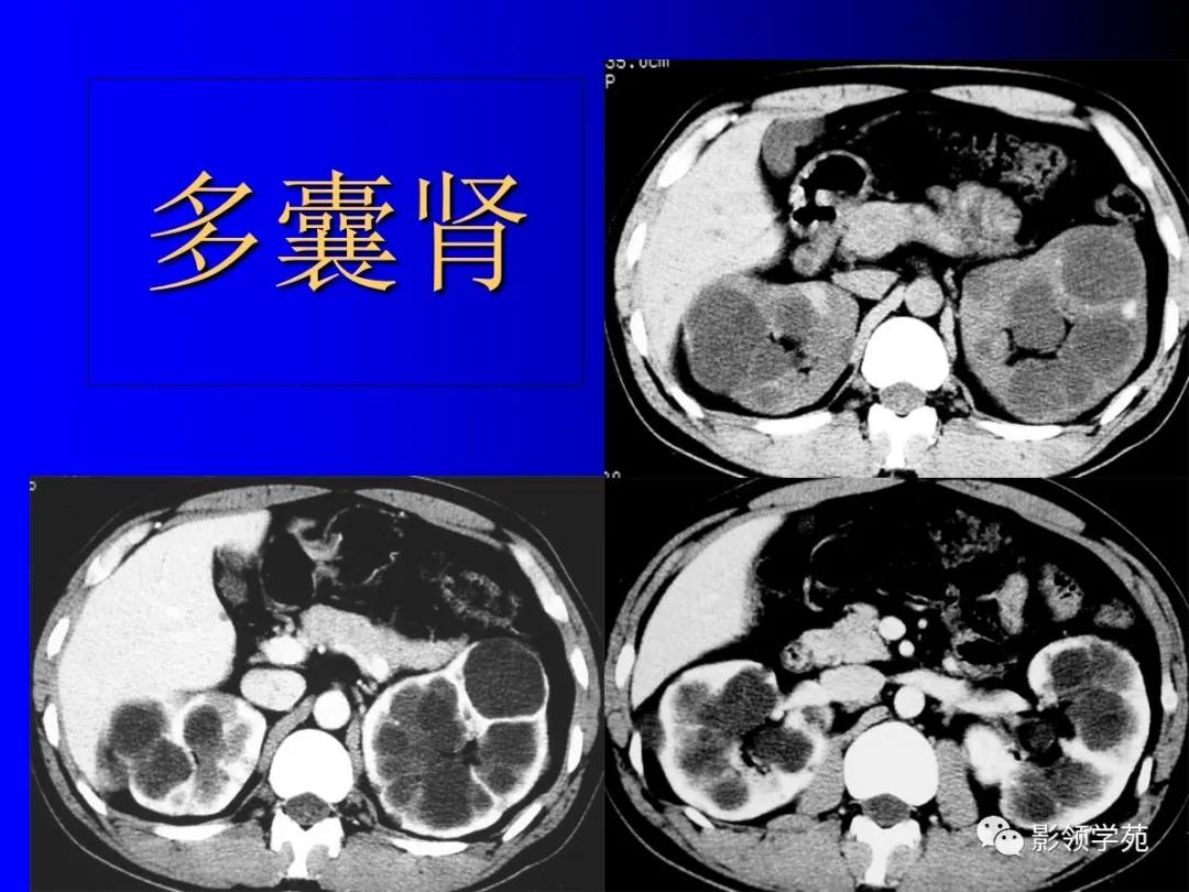 肾脏囊性肿块的影像学特点,肾脏典型病理图片及解析