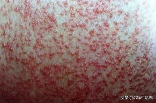 长痱子怎么办小妙招,夏天长痱子有什么食疗方法