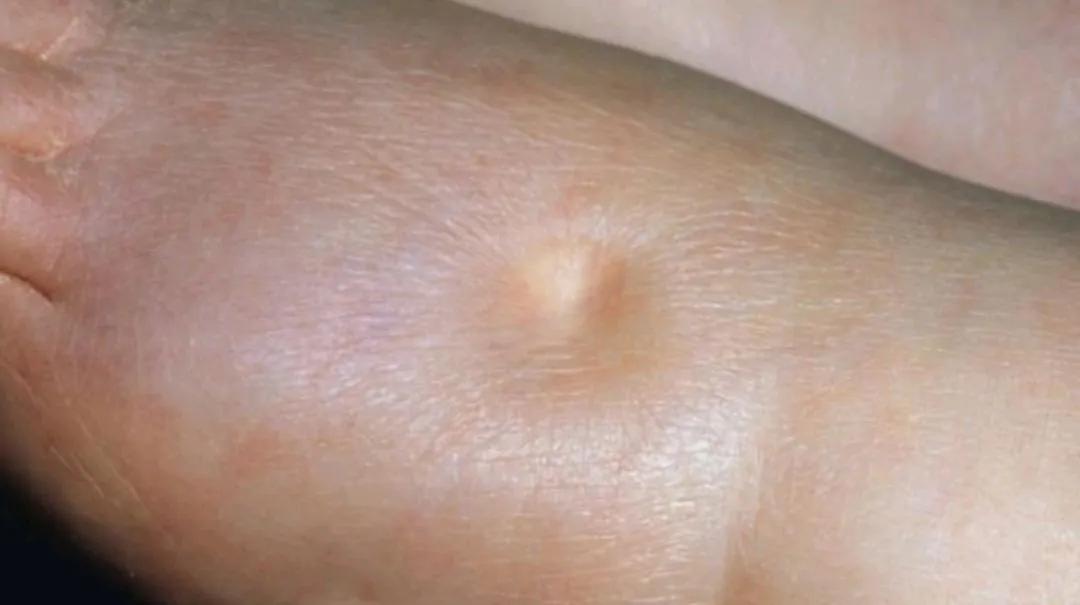 得了肾病综合征最好的治疗方法,得了肾病综合征吃哪些中成药