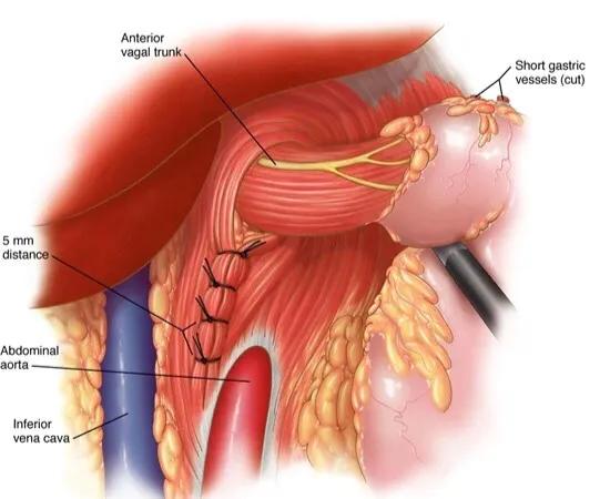 胃跑到胸腔了怎么办,胃跑到胸腔里做什么手术