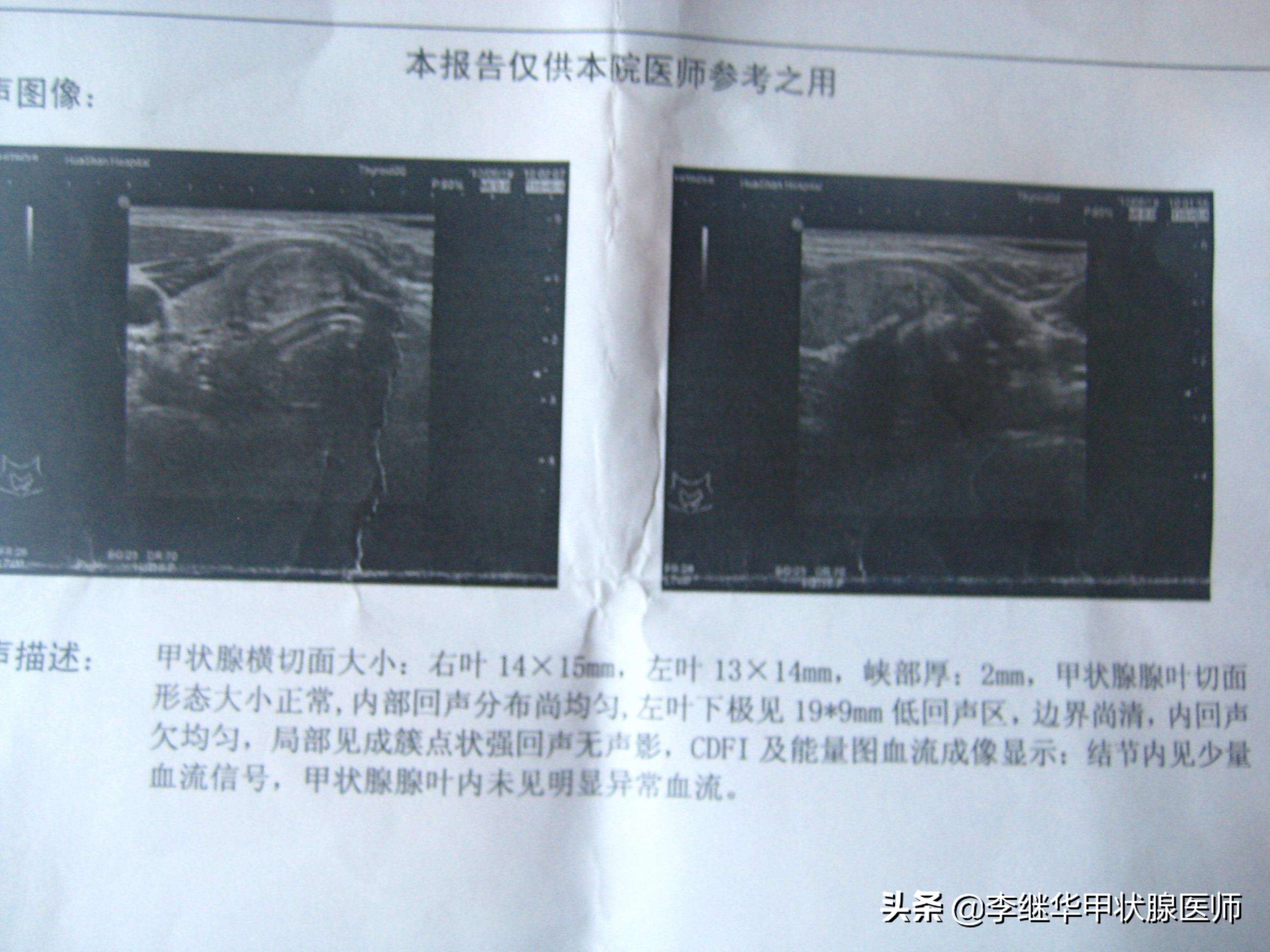 甲状腺结节多发伴钙化建议随访,甲状腺结节4b可以随访观察吗