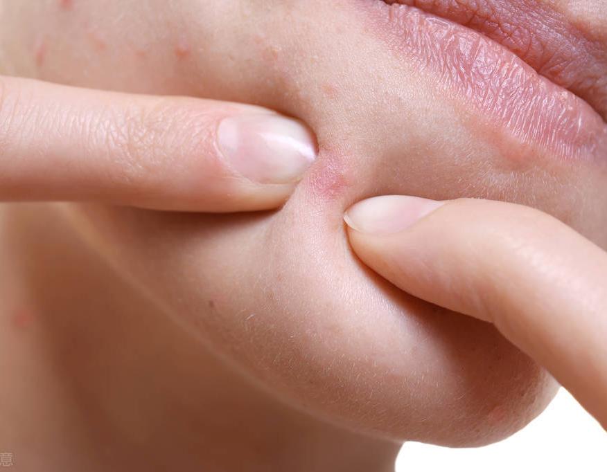 脂肪粒自愈的最佳小妙招,肉芽脂肪粒