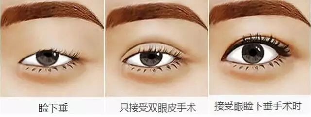 我想做个双眼皮,上睑下垂做了提肌双眼皮