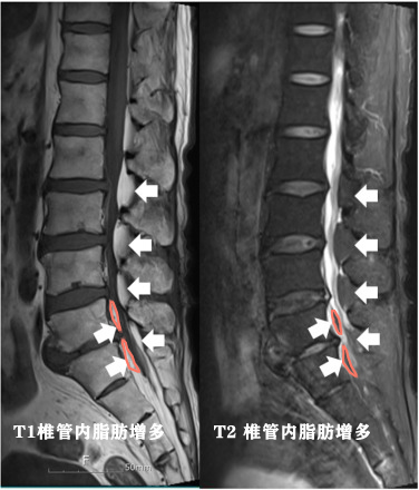 胃脂肪瘤有恶变吗,小肠脂肪瘤恶变吗
