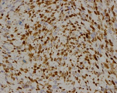 菁讲:你所不知道的横纹肌肉瘤