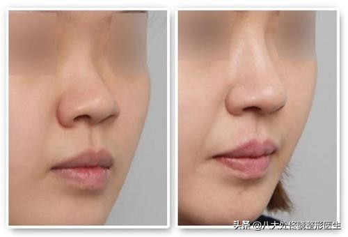 面部一枝花全靠鼻子当家,鼻子一针玻尿酸效果图