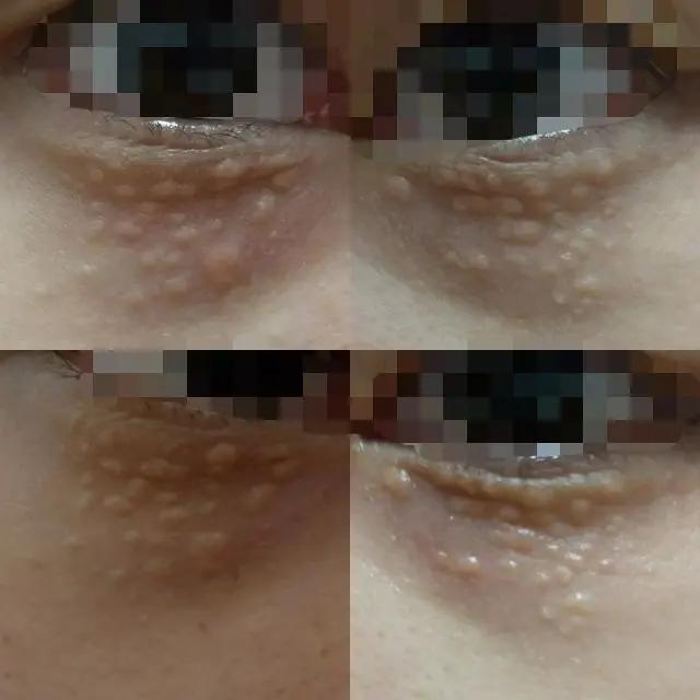 脂肪粒的形成原因以及消除方法,脂肪粒的形成原因以及去除方法