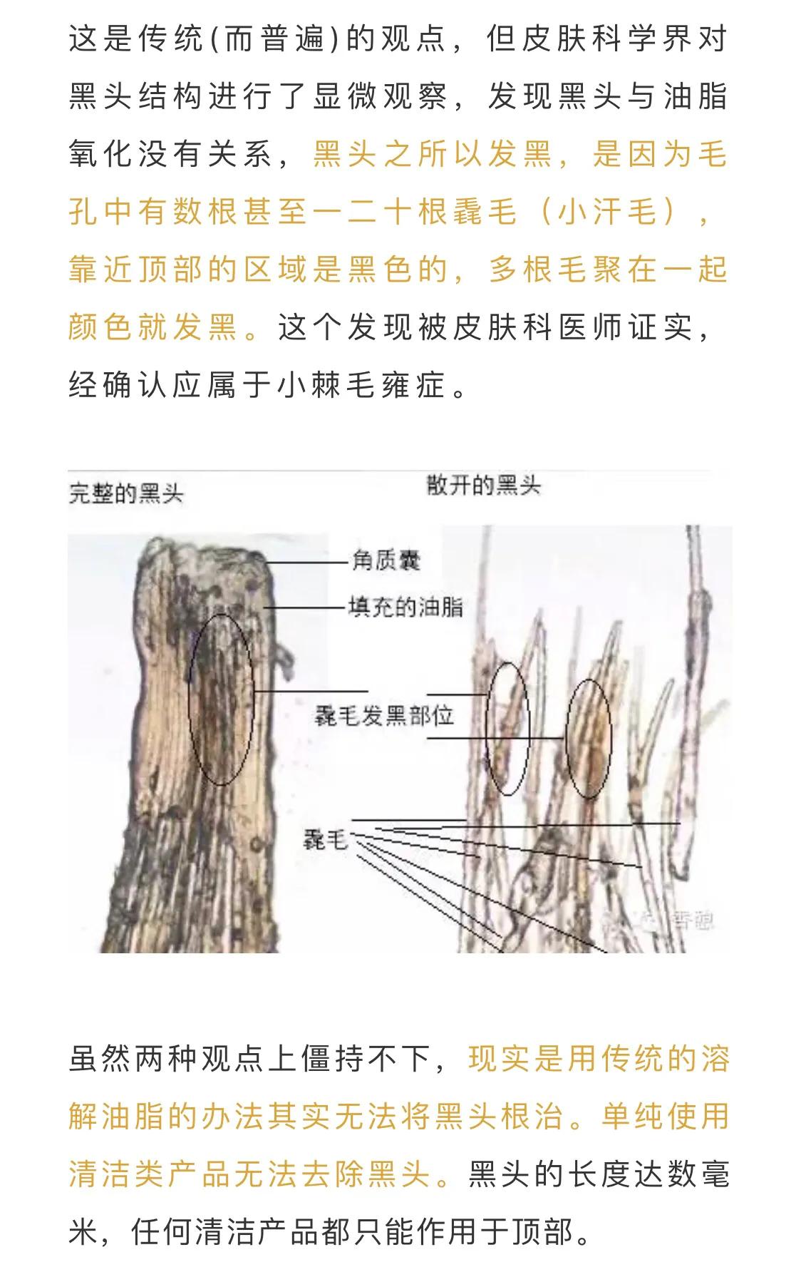 黑头到底有没有方法改善,你不知道的小知识黑头