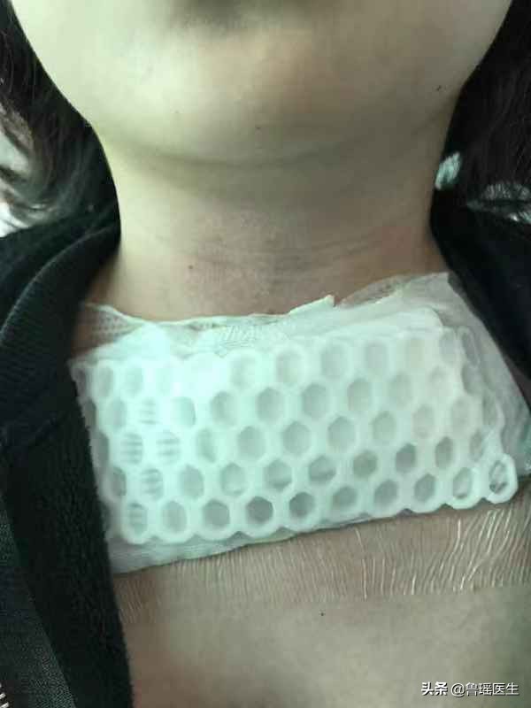 甲亢合并甲癌为什么要全切,甲亢合并甲状腺肿大怎么治疗