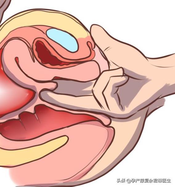 盆底知识问答,保护盆底的正确方法