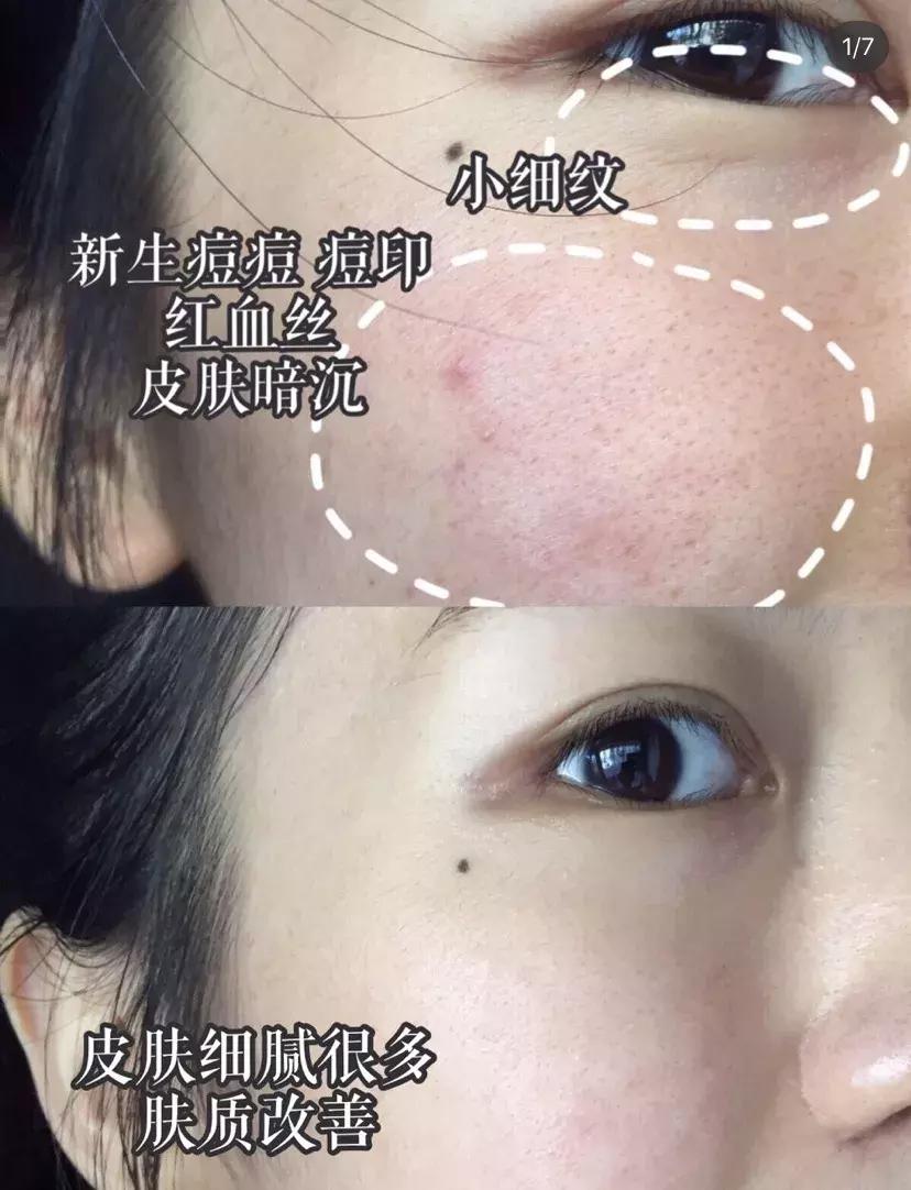 日本的美白针,日本最强美白针