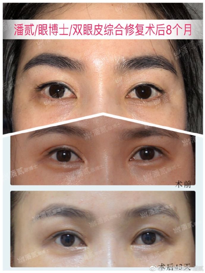 自己的双眼皮太深显老怎么修复,做的双眼皮一笑有皱纹怎么修复