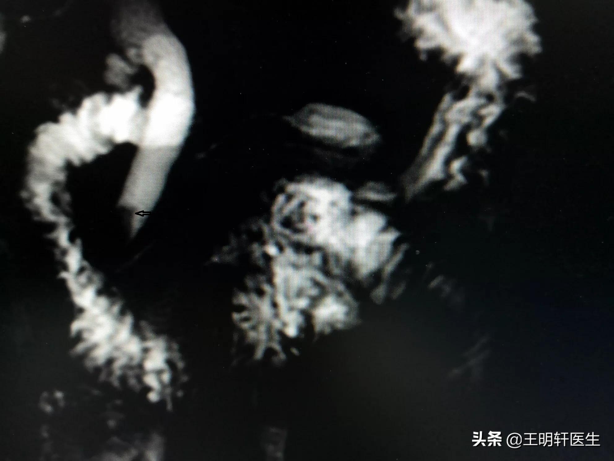 黄疸的分类和特点,黄疸的分类特点