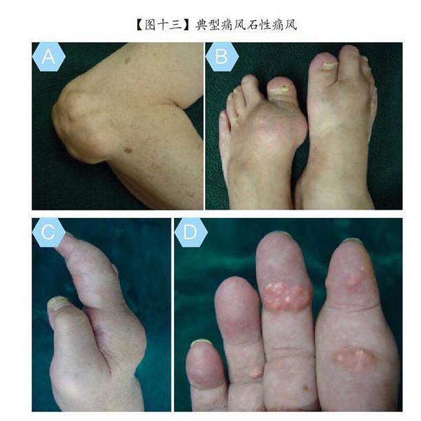 引起痛风疾病的主要原因是什么,中医解释痛风是什么原因引起的