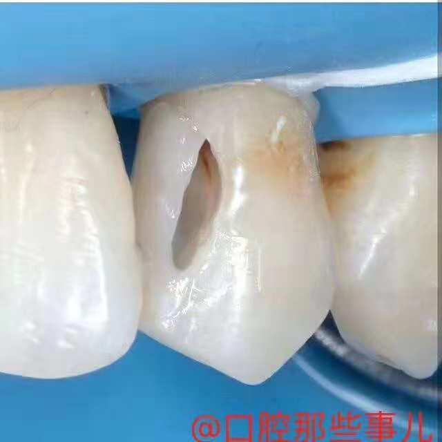 想要补个牙反而被磨了个大洞,大牙牙洞很大很深能补吗