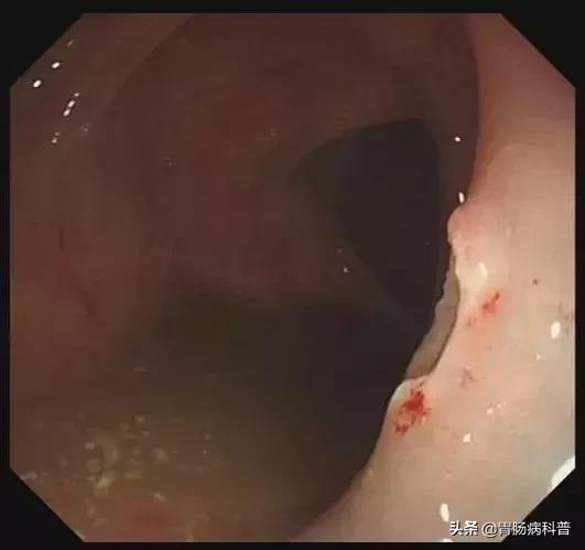 只要是肠息肉都要割掉吗,医生肠息肉切除后怎么处理伤口