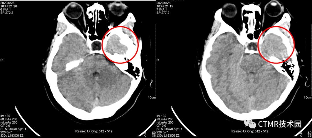 CT影像技术,脑部做ct有伪影是怎么回事