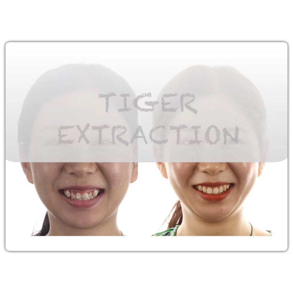 南京成人隐形牙齿矫正一般多少钱,隐适美牙齿矫正比较好的医院