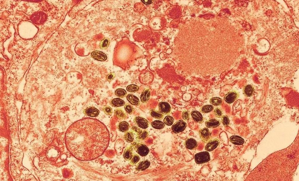 天花是怎么被消除的,天花怎么被根除的