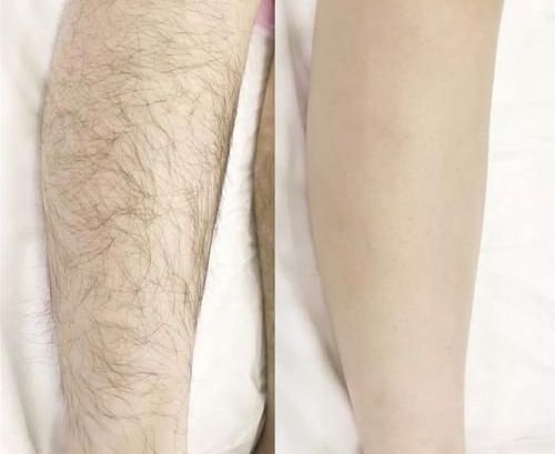 女人生理性体毛过旺是什么原因,体毛旺盛除了天生的还有什么原因