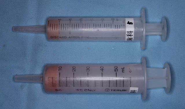 咬合重建的程序,咬合重建做嵌体