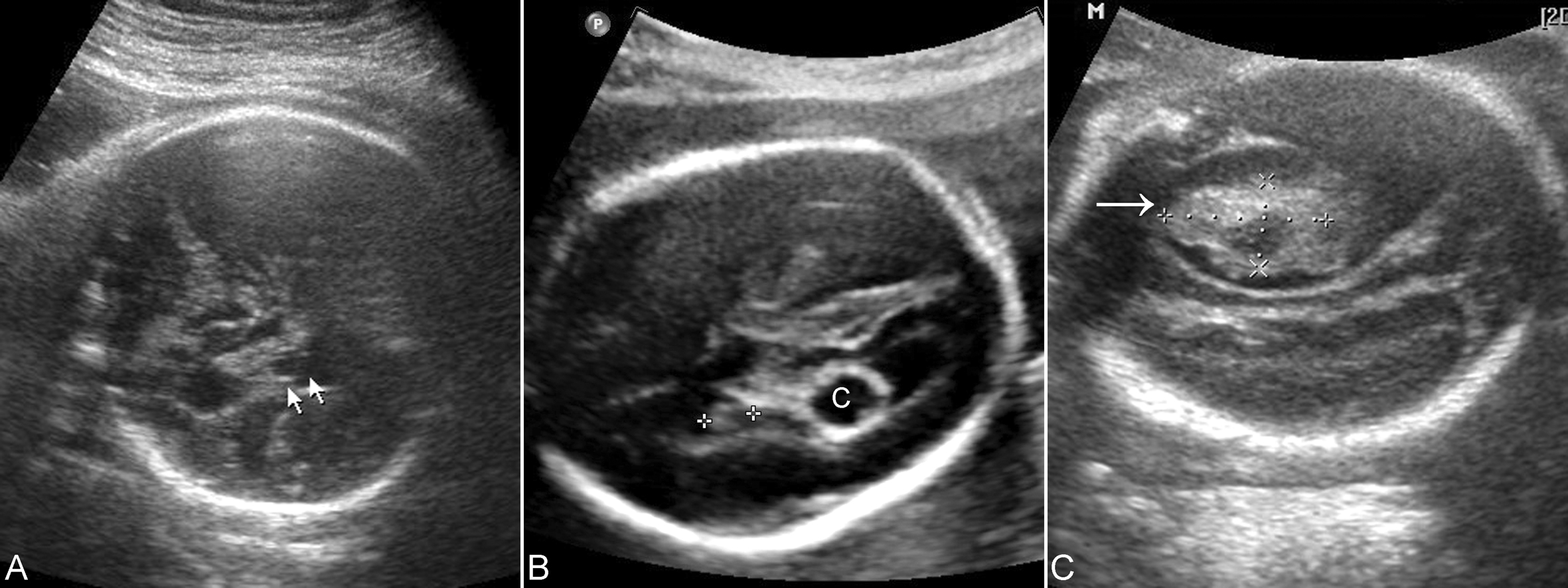 明明白白做b超,超声提示宫内单胎头位
