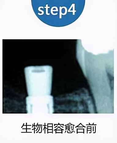 老人家种牙去哪里最好,50岁种牙最好方法怎么种