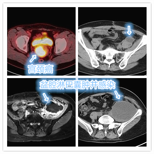 颈部淋巴囊肿反复发作,盆腔淋巴囊肿最快消除方法