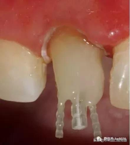 纤维桩的优点和缺点,看完这篇文章就明白了