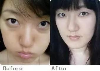 眼袋真实分享,介绍眼袋治疗视频