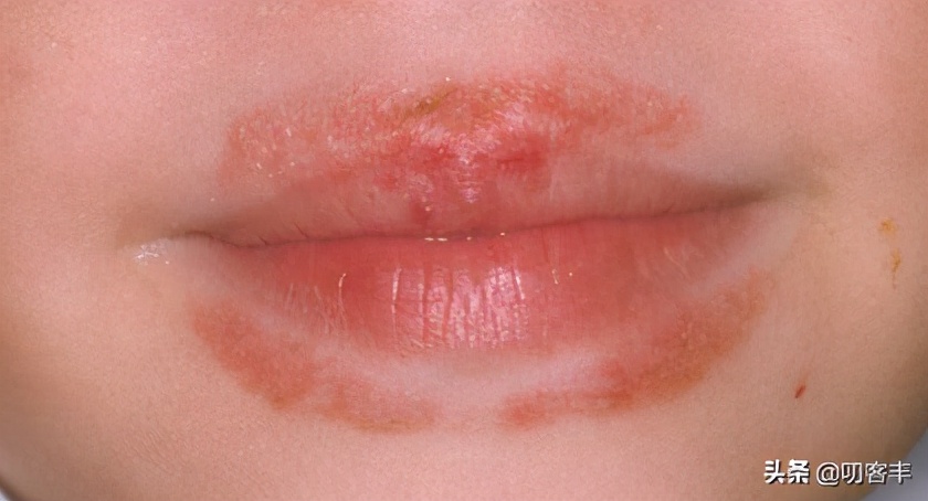 为什么冬天舔嘴唇嘴唇会辣辣的,冬天舔嘴唇是怎么回事