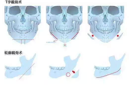 日式小颜整骨合法吗,日式小颜整骨可以维持多久