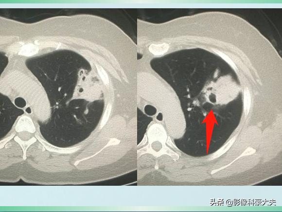 肺炎比肺结核严重吗,新冠肺炎对癌症有影响吗