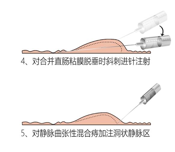 肛肠病诊疗新技术图解,实用肛肠病系列疗法新技术