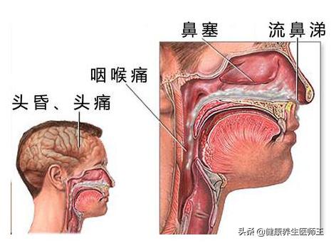 健康之道治鼻炎,急性鼻炎的图片