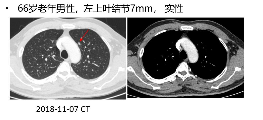 小细胞肺癌的气管镜介入治疗,导航支气管镜在肺癌诊断中的应用