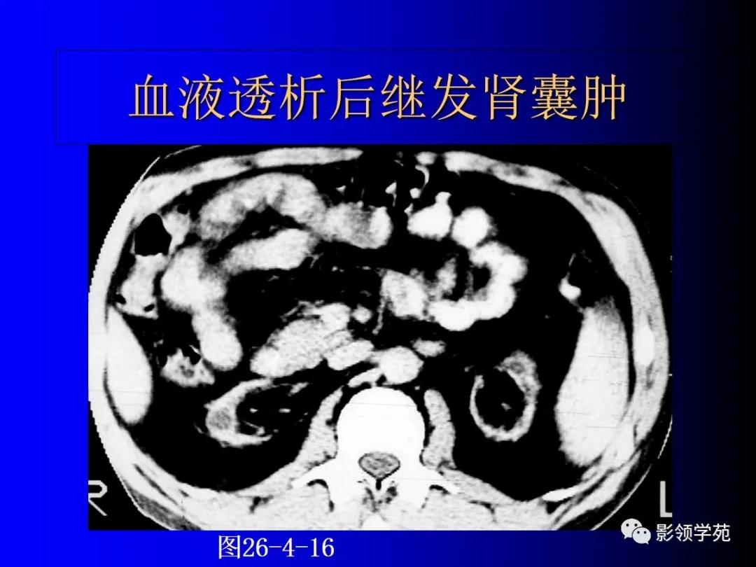 肾脏囊性肿块的影像学特点,肾脏典型病理图片及解析