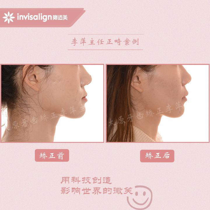 太原矫正牙齿需要做正颌吗,太原牙齿二次矫正