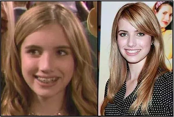 孩子地包天怎么治疗最有效,小孩地包天最佳治疗方法