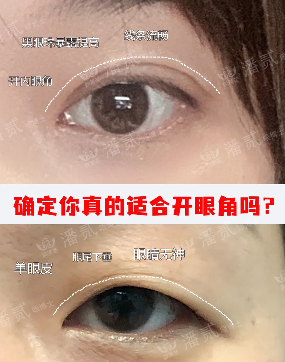 双眼皮眼尾割长了而且上扬怎么办,眼睛眼尾下垂做什么样双眼皮