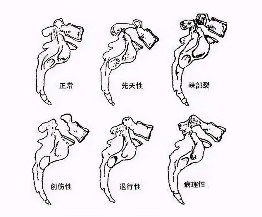 腰椎滑脱和腰椎滑移是一个概念吗,腰椎滑脱是不是骨折的意思