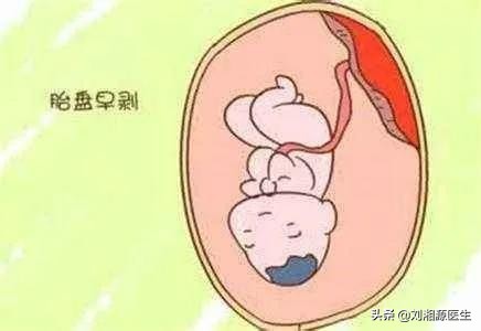 免疫保胎时孕妇出血的原因,免疫相关不良妊娠答疑解惑