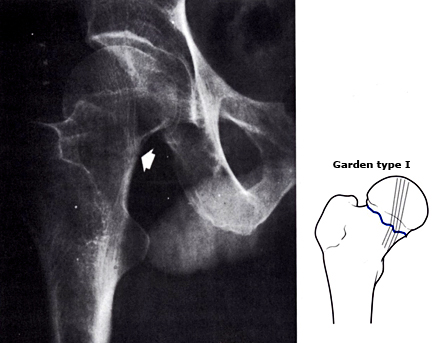 老年人摔到大胯怎么办,老人摔到胯骨多久死